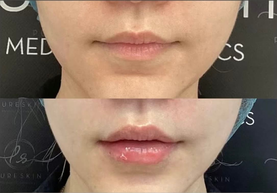 Lip filler before and after at PureSkin: balanced, subtly fuller lips