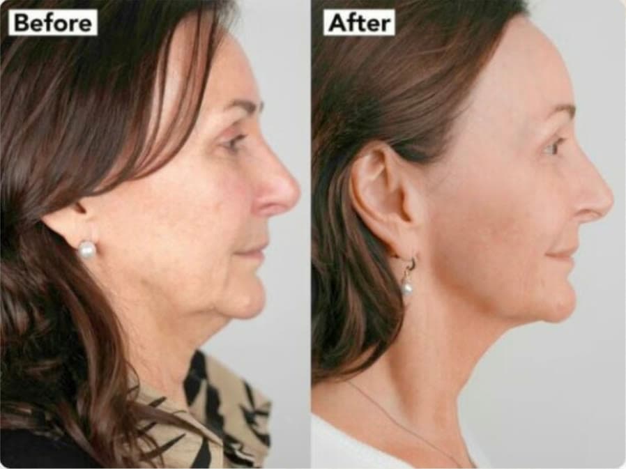 NeoGen nitrogen plasma before and after, profile view showing tighter neck and jawline