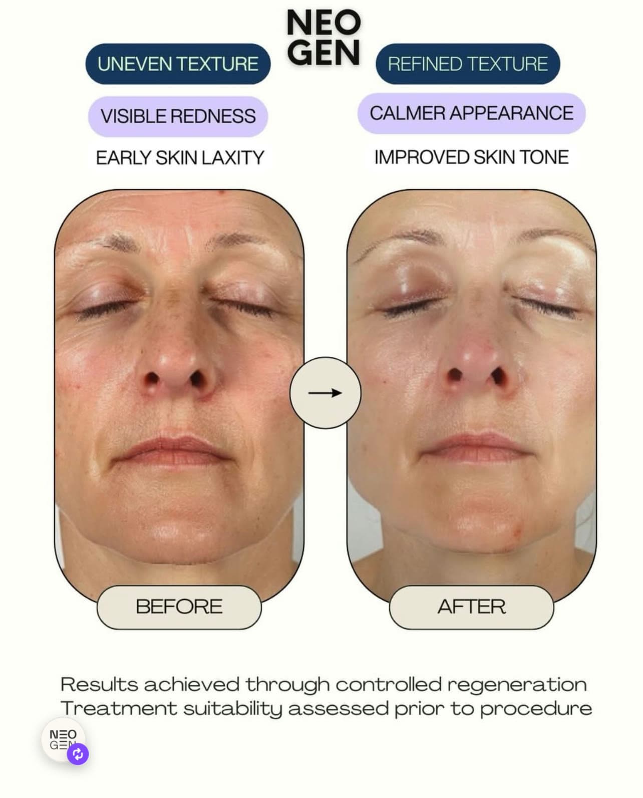 NeoGen before and after showing refined texture, calmer redness and improved skin tone