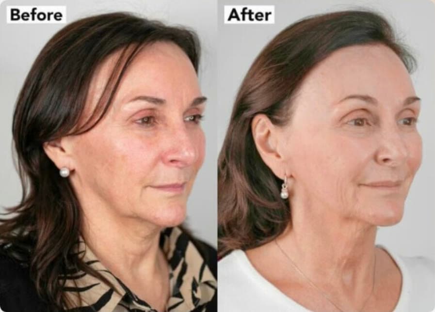 NeoGen nitrogen plasma before and after, three-quarter view showing firmer jawline and smoother skin